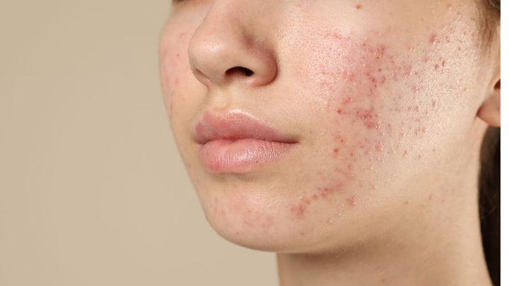 Lactoferrin and Acne: Could This Immune Protein Help Your Skin?